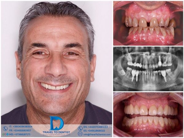 Caso 2 — Implantes dentales antes y después