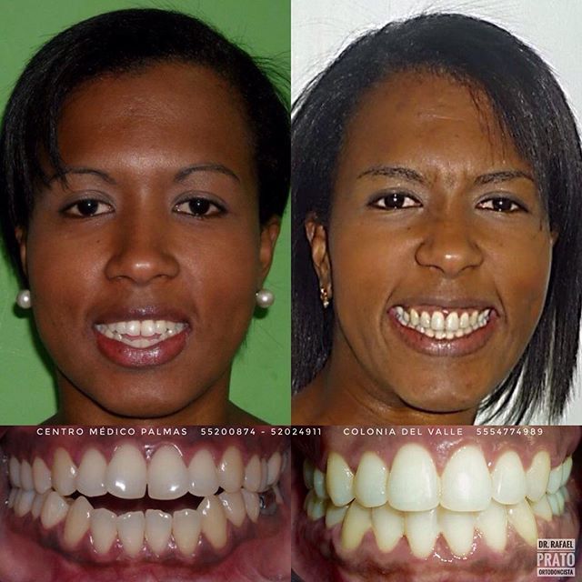 Caso 4 — Diseño de sonrisa antes y después